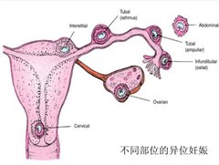宫外孕6