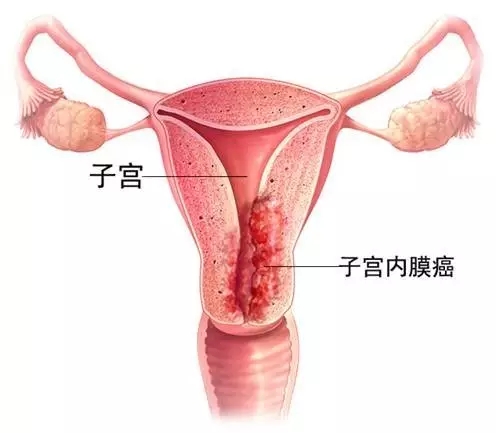 子宫内膜癌图片.webp